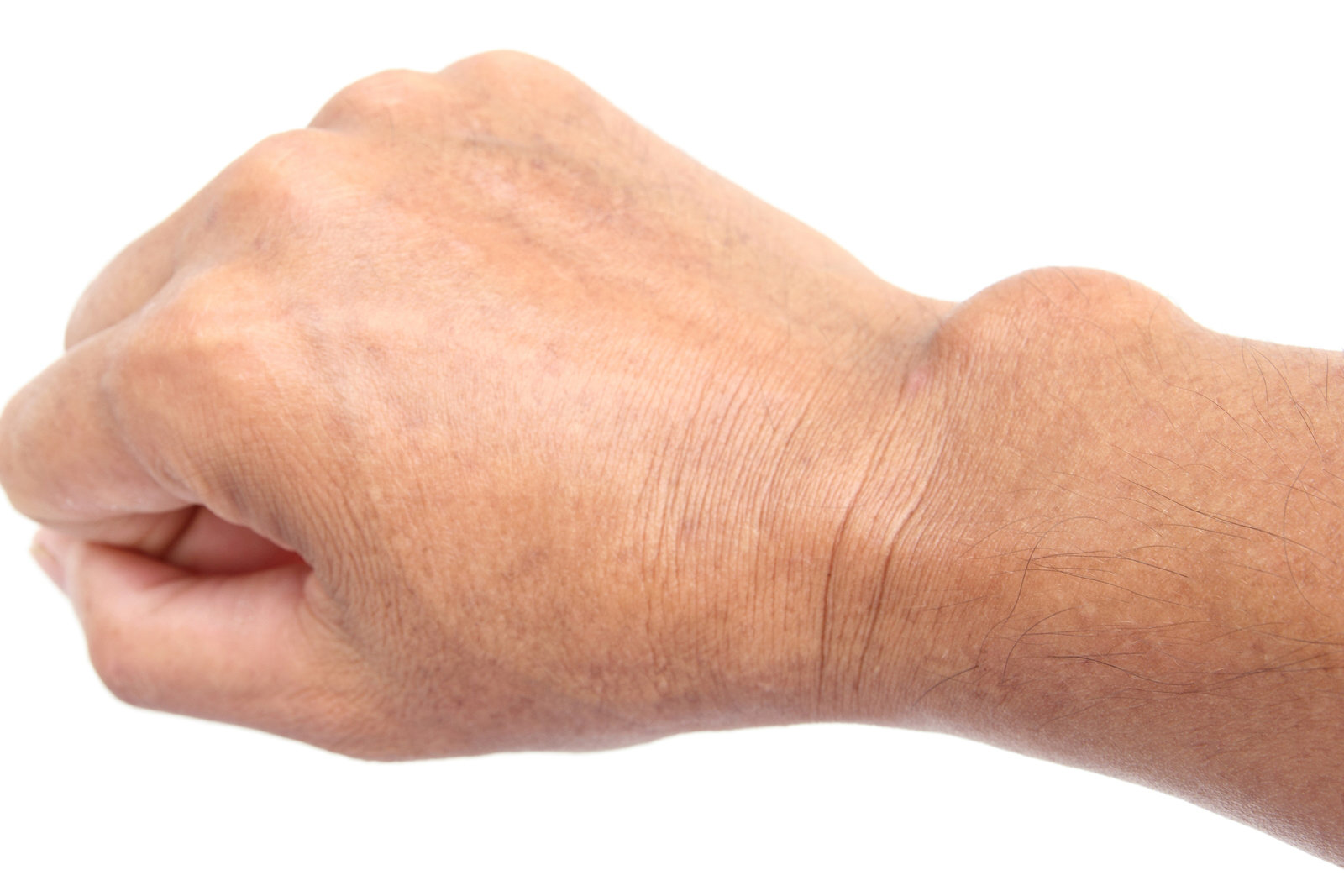 Ganglion Removal Essex Ganglion Removal Surgery In Essex