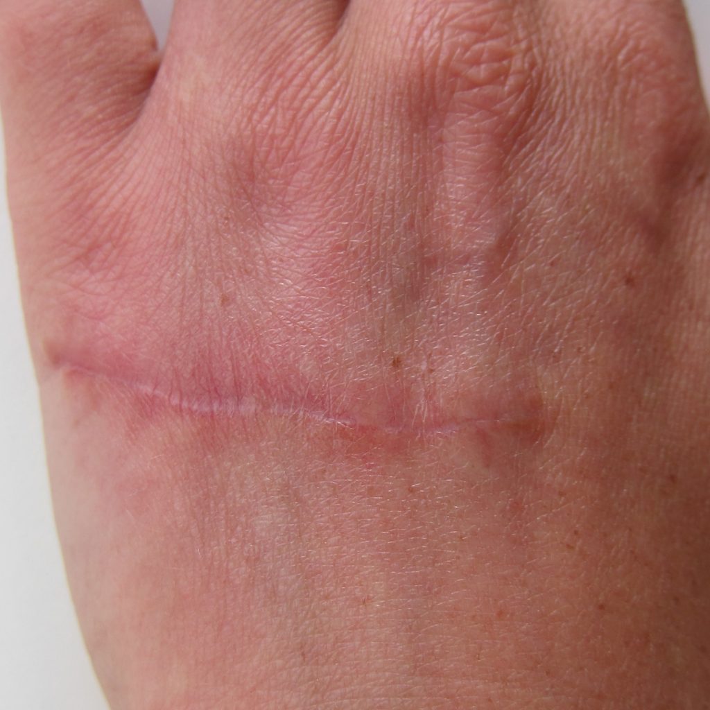 Mole Removal Essex, Expert Cosmetic Mole Removal Essex