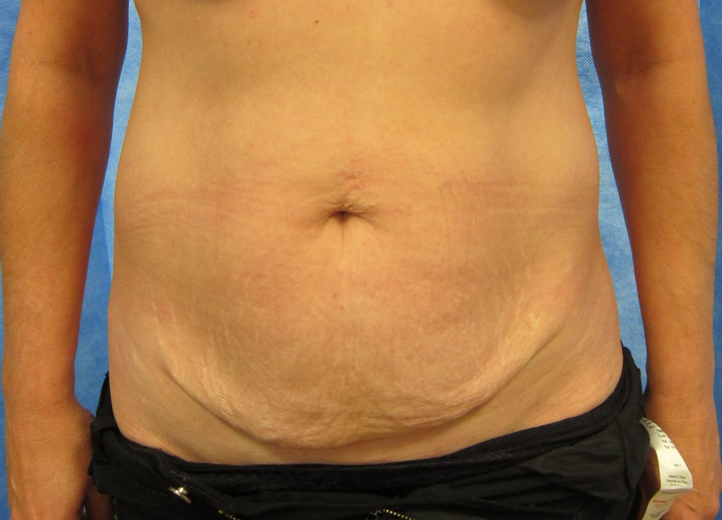 Before abdominoplasty surgery image