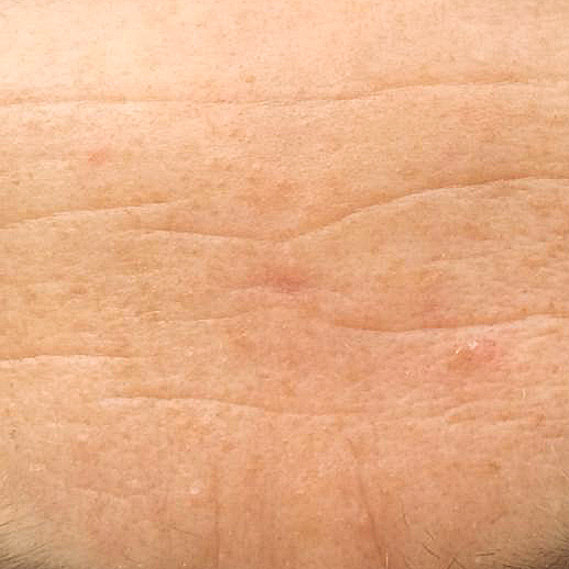 Mole Removal Essex, Expert Cosmetic Mole Removal Essex