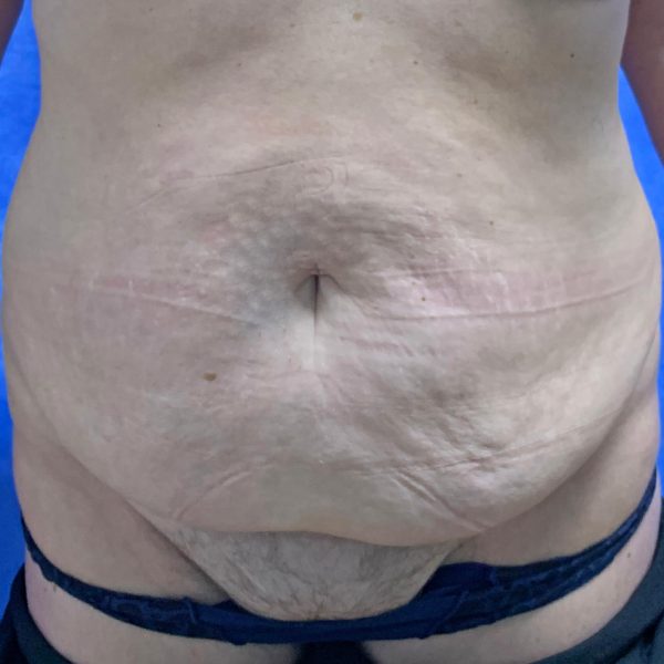 Abdominoplasty Before Front
