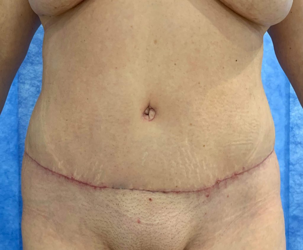 Abdominoplasty Surgery Essex, Book Your Initial