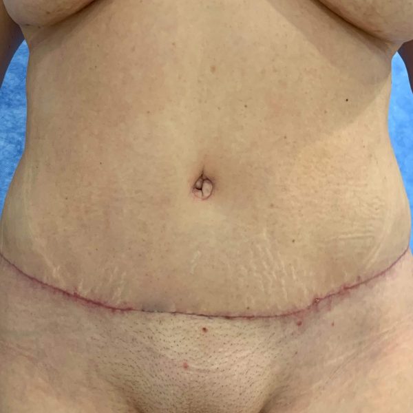 Abdominoplasty After Front