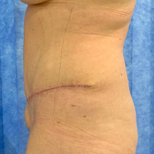 Abdominoplasty After Side