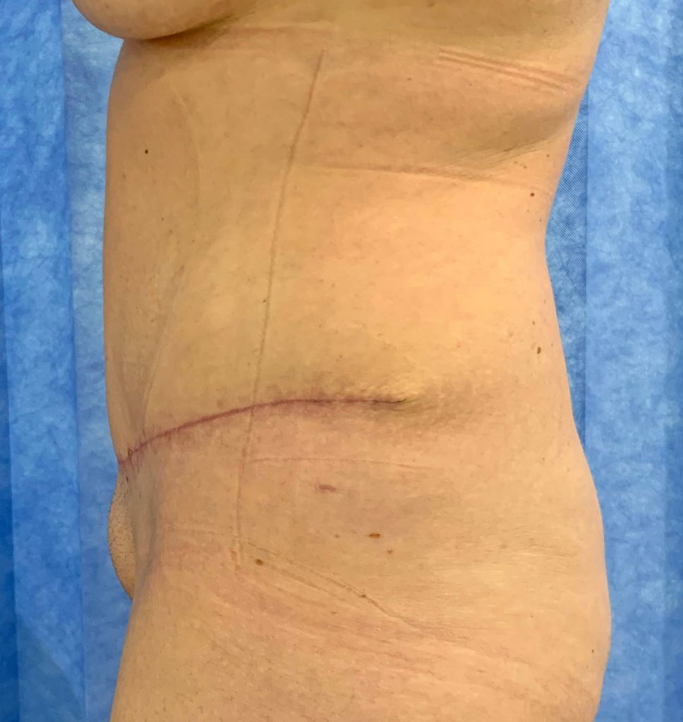 Abdominoplasty Surgery Essex, Book Your Initial Consultation Now!