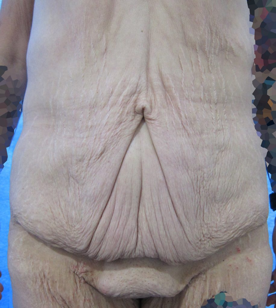 Before Fleur de Lis Abdominoplasty surgery