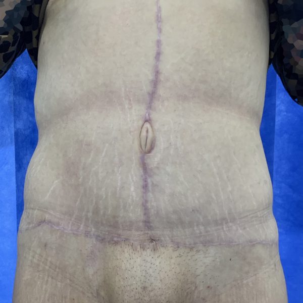 8 months after Fleur de Lis Abdominoplasty surgery
